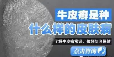 潍坊牛皮癣专家讲解，牛皮癣是一种什么病?