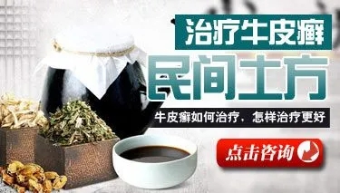 牛皮癣最常见的偏方有哪些呢