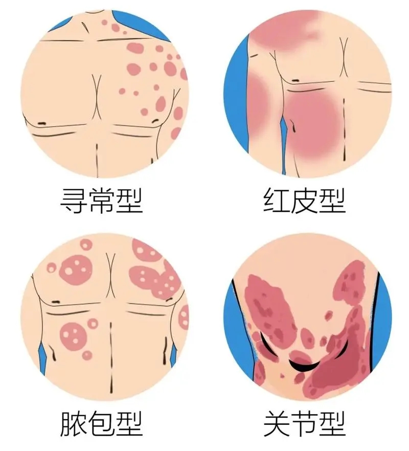 关节型牛皮癣的日常护理知识